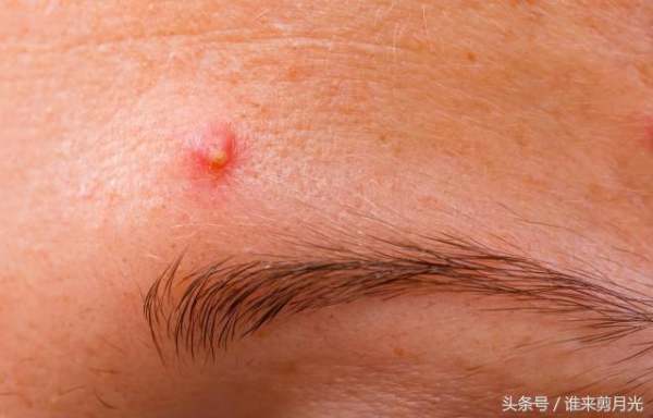 痘痘怎么消除小妙招 八种方法轻松解决你的烦恼?