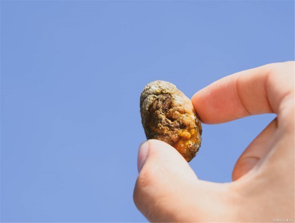 肾结石怎样治最好?