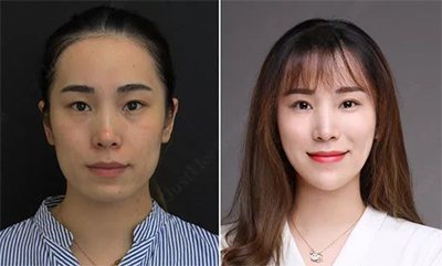 能看一下你打完瘦脸针的前后对比图吗