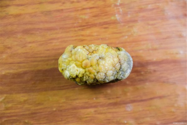 肾结石怎样治最好?