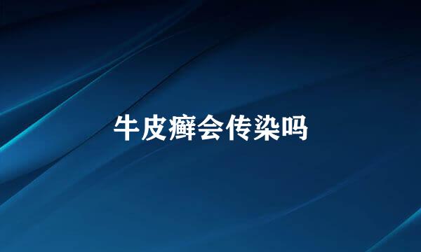 牛皮癣会传染吗
