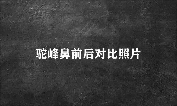驼峰鼻前后对比照片